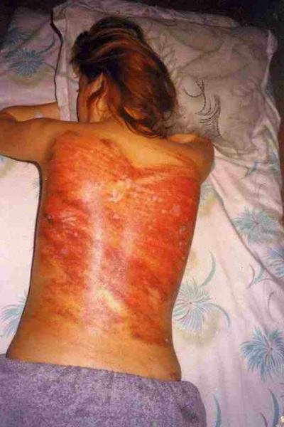 Lashings on back of woman